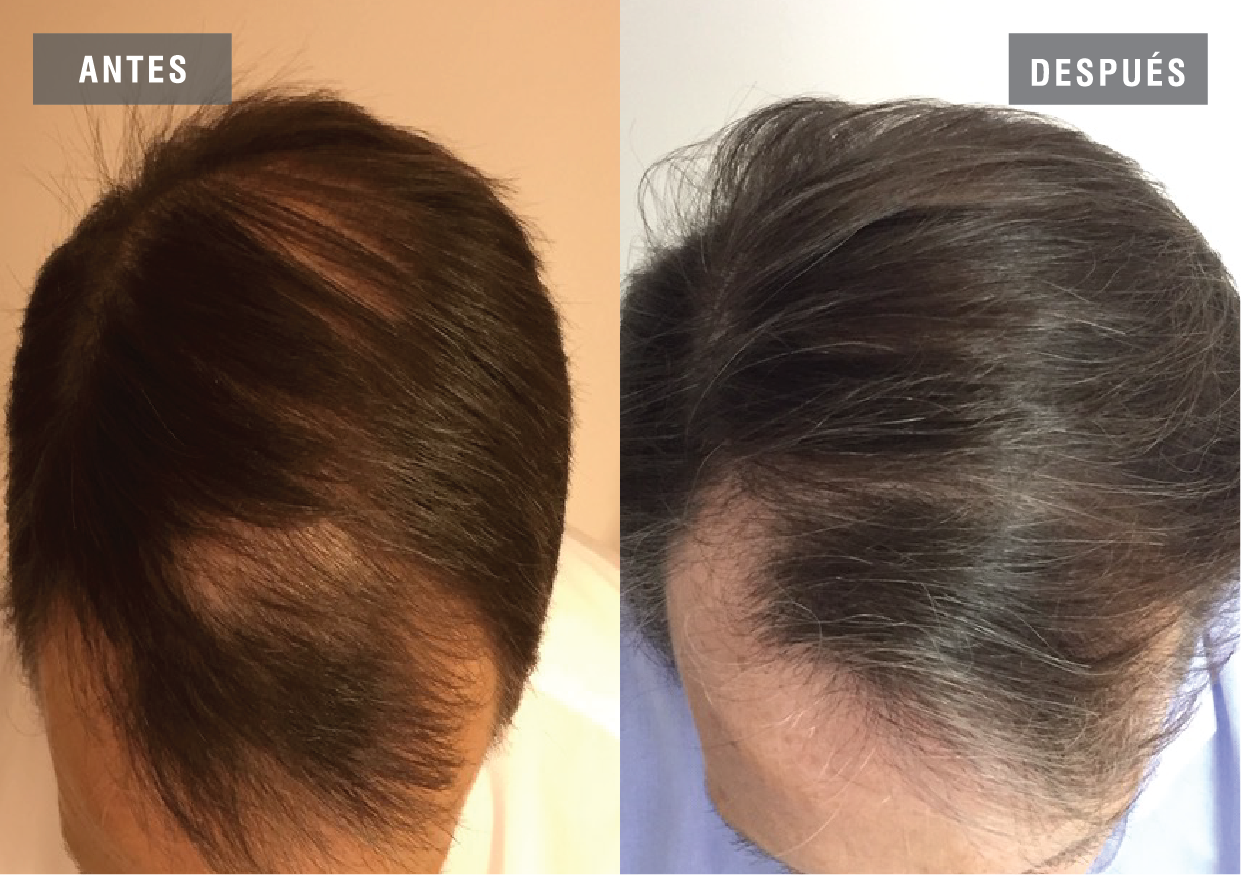 El tratamiento de la alopecia por Regenera Activa es desarrollado tanto para hombres como para mujeres y estimula la creación de nuevo pelo y su crecimiento en un tiempo mínimo, así como el desarrollo del ciclo capilar evitando la caída y mejorando la calidad y densidad del pelo ya existente.