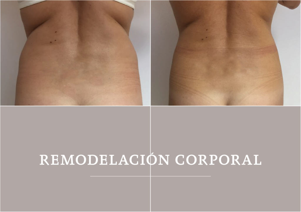 Deep Slim. Remodelación corporal