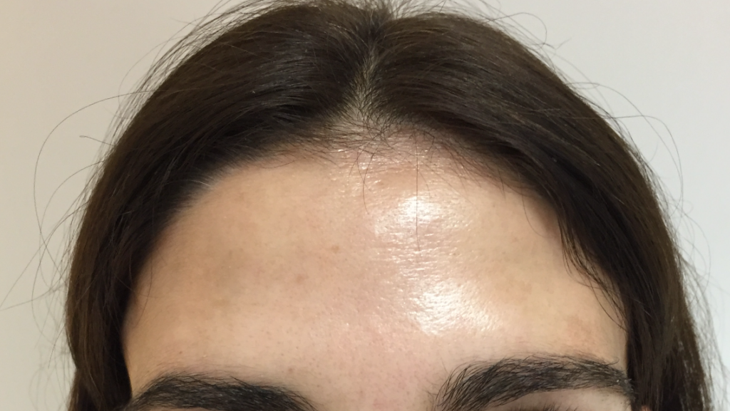 El tratamiento de las arrugas en la frente. Tratamiento de bótox en León