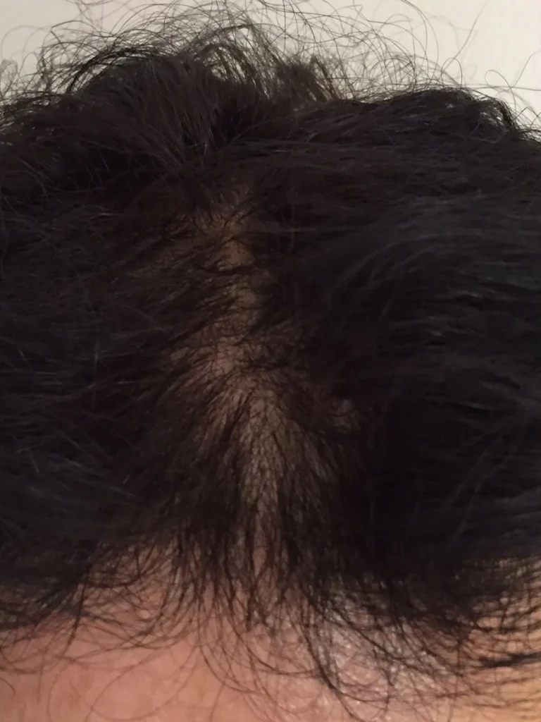 El tratamiento de la alopecia en León