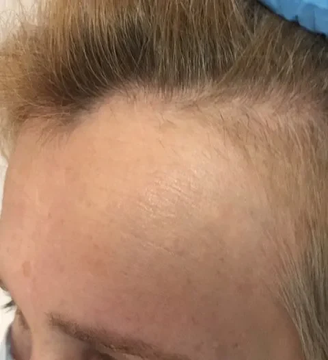 alopecia androgénica en mujeres