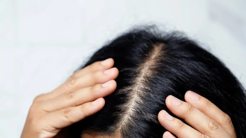 Tratamiento de la alopecia androgénica en León