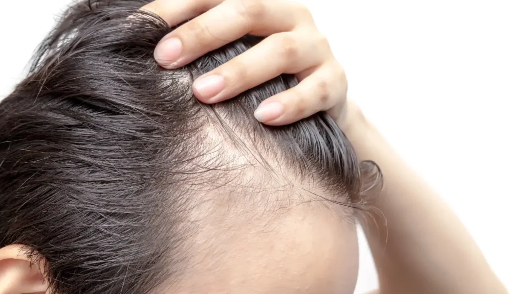 Regenera Activa. Tratamiento de la alopecia androgénica en León