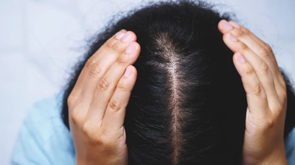 El tratamiento de la alopecia androgénica en León