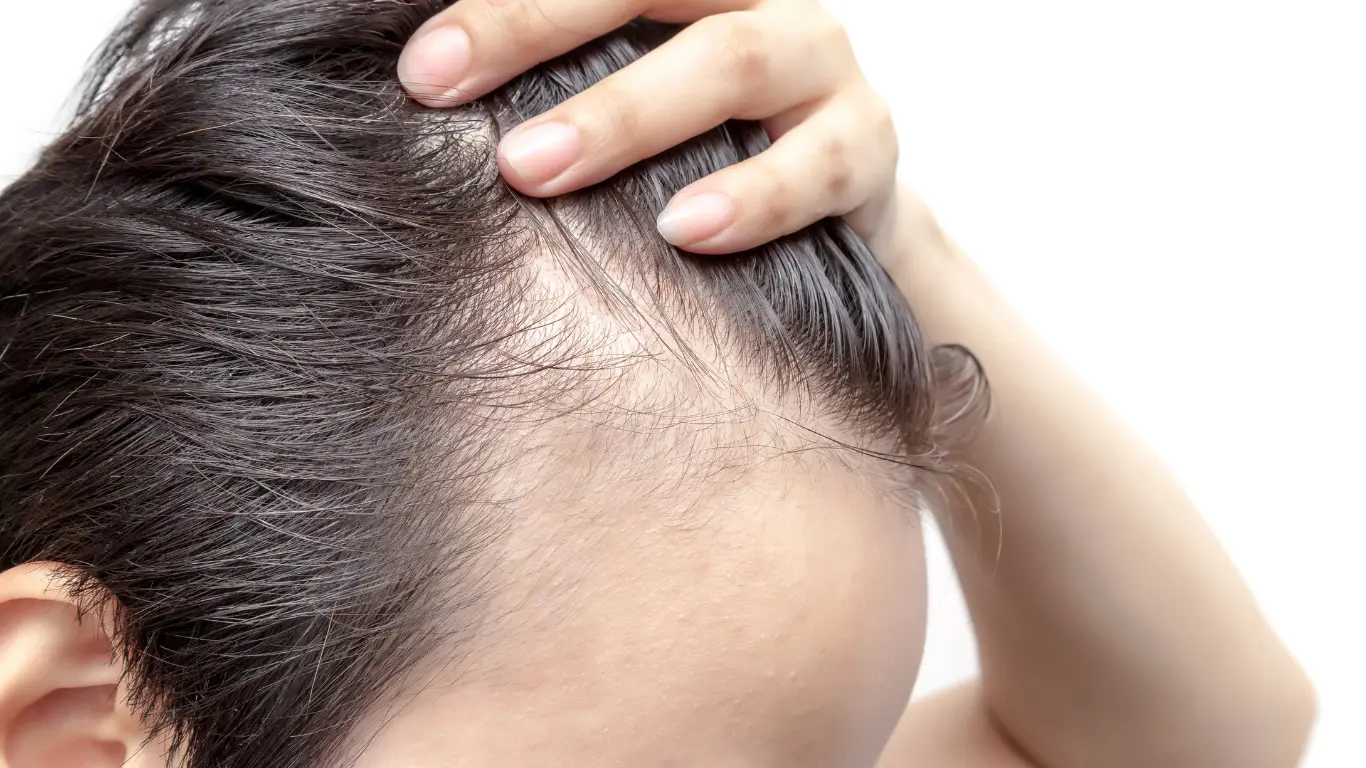 EL TRATAMIENTO DE LA ALOPECIA femenina04