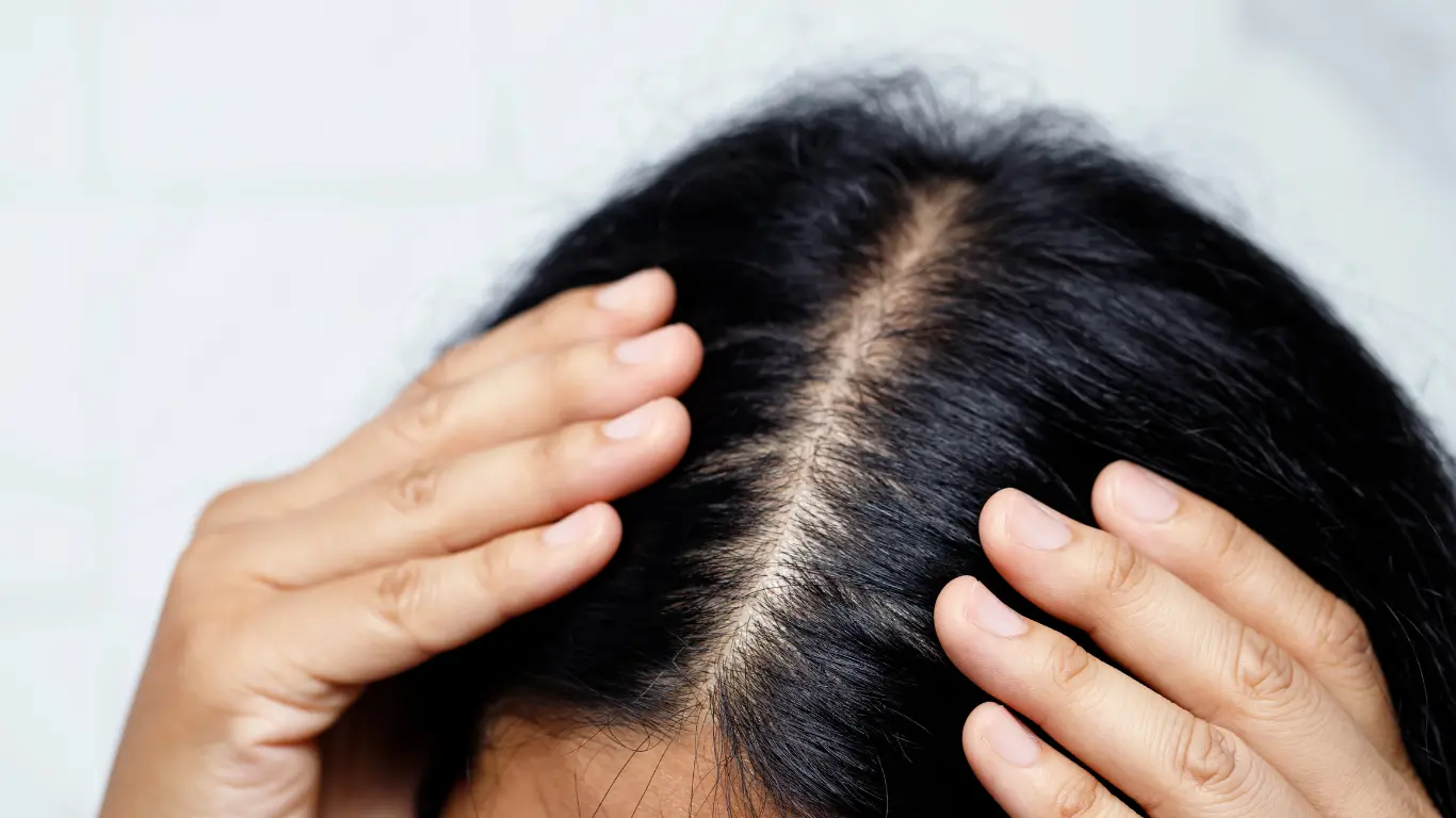 el tratamiento de la alopecia androgénica